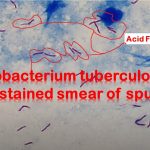 Ziehl-Neelsen Stain Introduction, Principle, Procedure, Result Interpretation and Keynotes