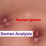 Semen Test: Introduction, Physical, chemical, microscopic examination, normal range of sperm count and clinical significance