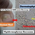 Fungal Nail Infection: Introduction, Mode of Infection, Symptoms, Prediposing Factors, Lab Diagnosis, Treatment, Prevention and Keynotes