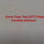 GTT for Candida : Introduction, Principle, Procedure, Result Interpretation and Keynotes