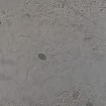 Sclerotic cells-Introduction, Lab Diagnosis, Clinical Significance, and Keynotes